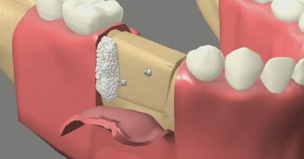 6 Benefits of Bone Grafting in Largo for Dental Implants