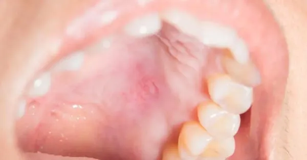 What causes a bump on the roof of the mouth?