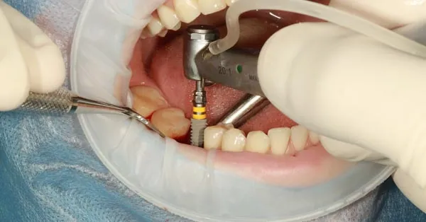 What Are the Common Side Effects of Dental Implant Surgery?