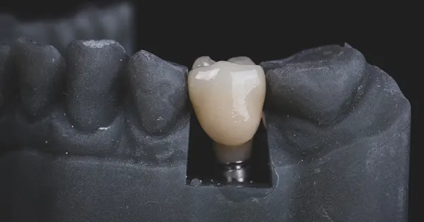 Dental Implants: A Great Alternative to Dentures and Bridges