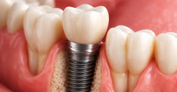 3D illustration of Dental Implants in Largo showing a titanium implant post with a natural-looking crown placed securely in the gum and jawbone.