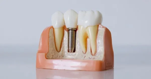 What Are Dental Implants?