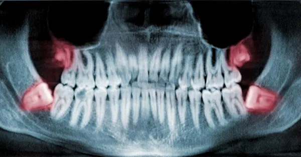 When Should I Have my Wisdom Teeth Removed?